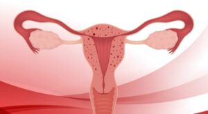 adenomiose-clinica-cirurgica-glamis-amazonas-ginecologista-campinas-sp