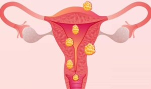 miometase-uterina-histeroscopia-clinica-cirurgica-glamis-amazonas-ginecologista-campinas-sp
