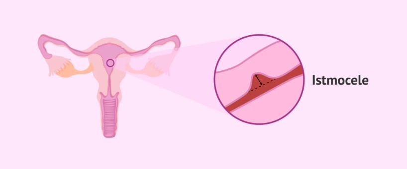 istmocele-uterina-clinica-cirurgica-glamis-amazonas-ginecologista-campinas-sp