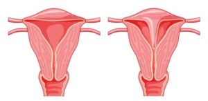 utero-septado-septo-uterino-Dra-Glamis-Amazonas-medica-ginecologista-em-campinas