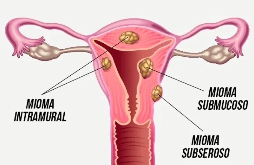miomas-submucosos-video-histeroscopia-clinica-cirurgica-glamis-amazonas-ginecologista-campinas-sp